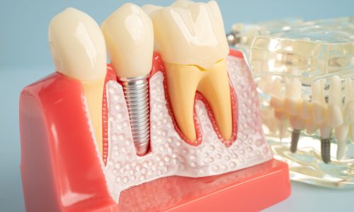 Dental implant, artificial tooth roots into jaw, root canal of dental treatment, gum disease, teeth model for dentist studying about dentistry.