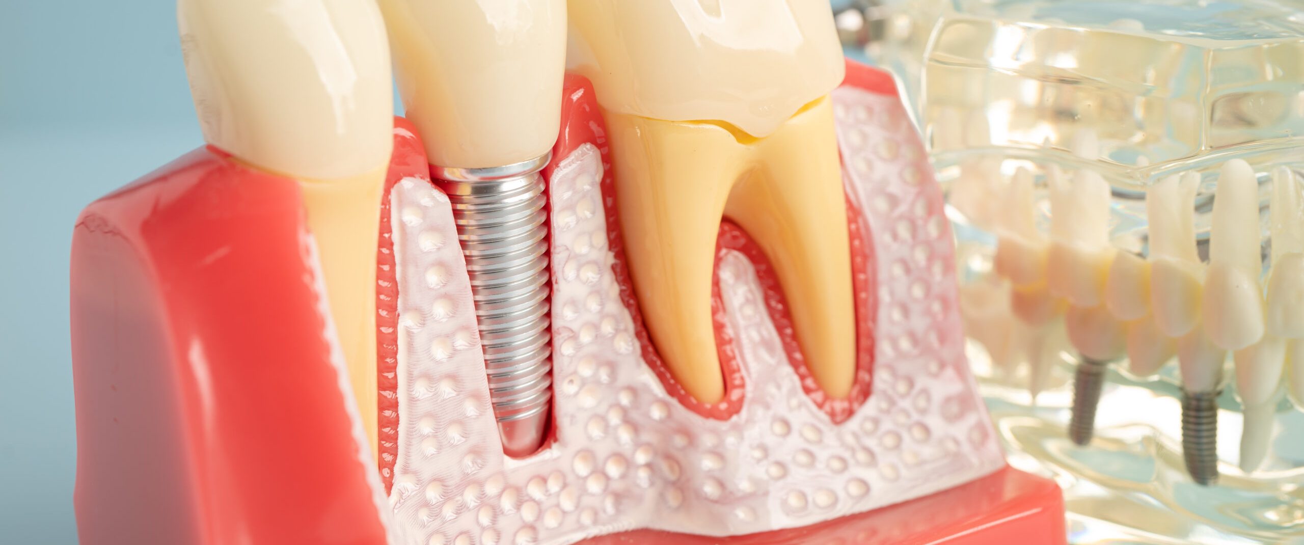 Dental implant, artificial tooth roots into jaw, root canal of dental treatment, gum disease, teeth model for dentist studying about dentistry.