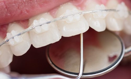 Dentist checking up teeth with ceramic brackets using dental tools - probe and mirror at the dental office. Macro shot of teeth with braces. Orthodontic Treatment. Dentistry